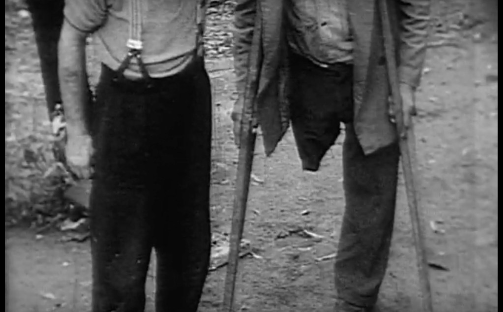 Two men, recording that one has lost his leg - from NBN News Film AF7-AF9 circa April-May 1963.